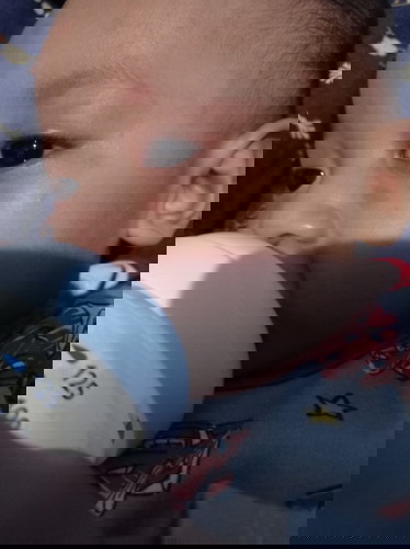 Kemerahan pada wajah bayi