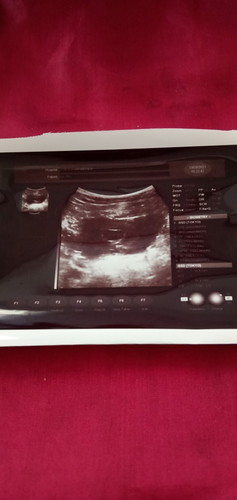 Usg 7 minggu cuma ada kantong janin