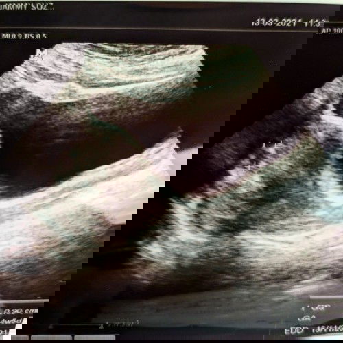 Keputihan bercampur darah (7weeks)