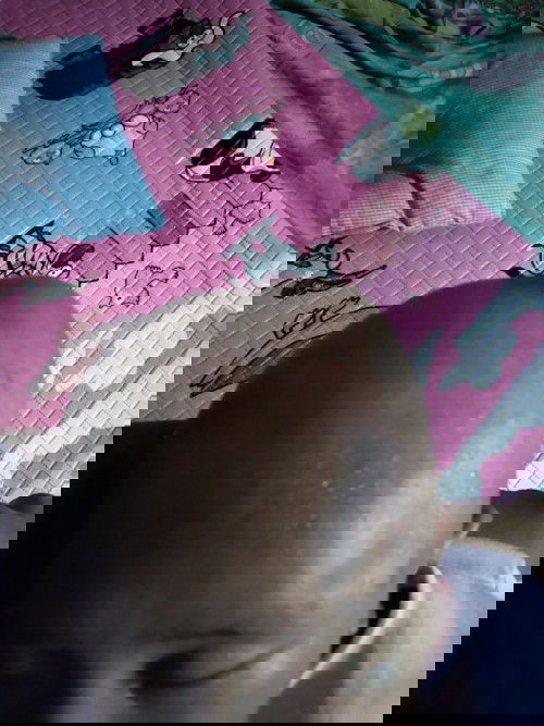 Benjol akibat lama berhenti mengedan dan peyang