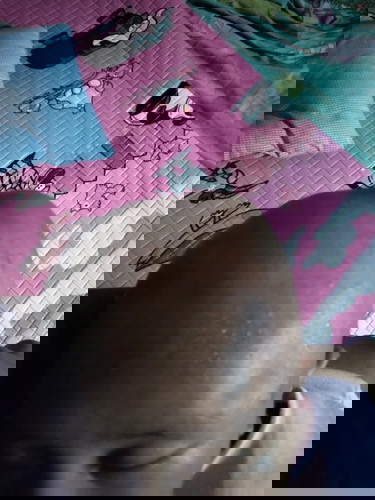 Benjol akibat lama berhenti mengedan dan peyang