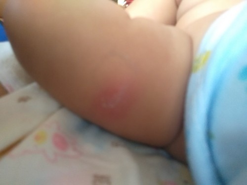 รอยฉีดวัคซีน