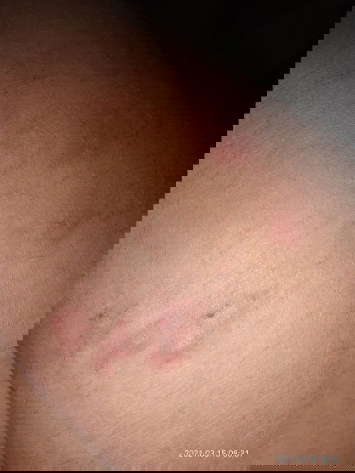 Kulit gatal dan memerah