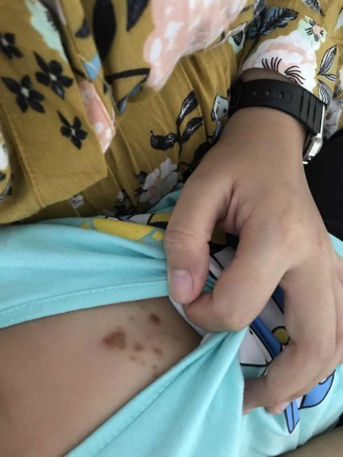 kulit sensitif atau alergi