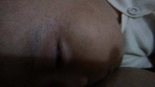 Saran Obat luar untuk alergi cuaca panas? Selain caladine