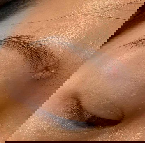 ติ่งเนื้อตอนท้อง