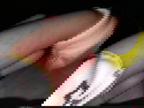 Kulit bayi merah berair