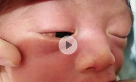2 days old baby may pula sa loob ng mata sa white part ng mata. Anu po kaya ito???