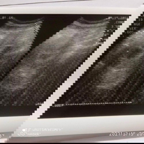 Usia kehamilan 7 weeks