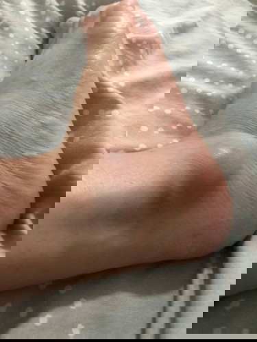 ตั้งครรภ์ 15 สัปดาห์ ตาตุ่มบวมแบบไม่เจ็บแล้วเป็นข้างเดียว มีใครเคยเป็นไหม