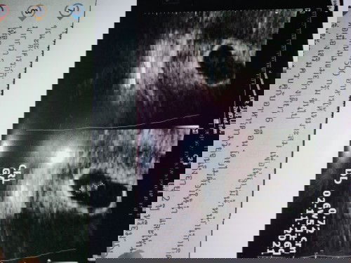 อายุครรภ์ 9 week เมื่อวานคุณหมอซาวด์ให้บอกว่าท้องนี้อาจไม่สำเร็จ  น้องยังตัวเล็ก และเห็นไม่ชัด