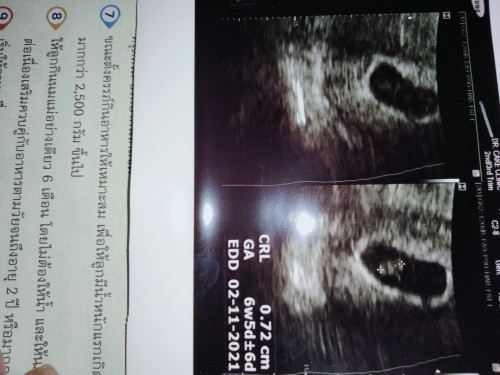 อายุครรภ์ 9 week เมื่อวานคุณหมอซาวด์ให้บอกว่าท้องนี้อาจไม่สำเร็จ  น้องยังตัวเล็ก และเห็นไม่ชัด