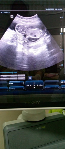 Ini aku baru USG anak pertama aku masuk kehamilan 15 Minggu bun. Tapi perut masih kecil belum buncit