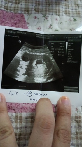 Cyst (ketumbuhan)