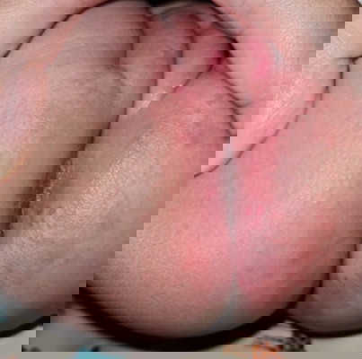 Worse diaper rash and Diarrhea