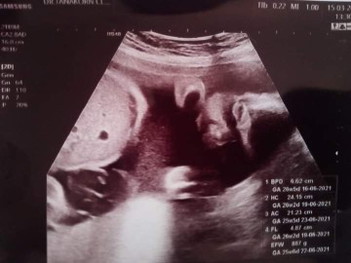 26w5d นน.887gแล้วคะดิ้นดีมากแม่น้ำหนักขึ้นมา8/9โลเลย แม่ๆน้ำหนักน้องเท่าไรแล้วค่ะ
17มิถุนายน ลูกสาว