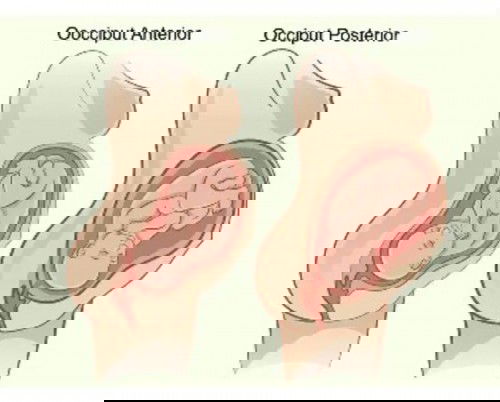 Posisi janin posterior