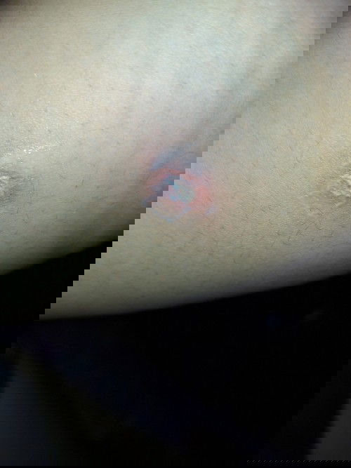 Cacar air atau herpes