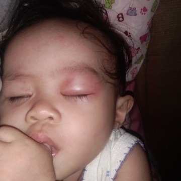 Baby swollen eyes