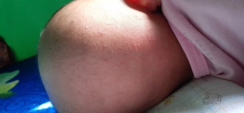 Cara atasi biang keringat