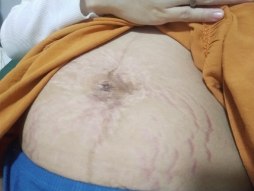 Stretchmarks at pusod