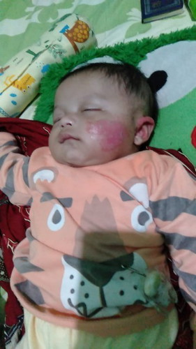 Anak alergi susu sapi brapa alergi itu hilang & makanan apa untuk menyembuhkan nya selain minum obat