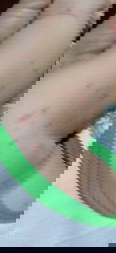 Gamot po sa rashes ng baby ko