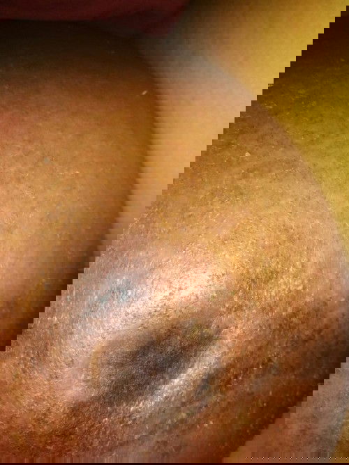 Ruam merah pada perut