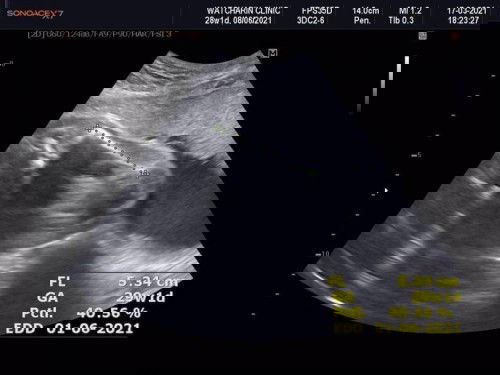 อัลตร้าซาวพบว่าลูกขดตัวจนตัวงอ