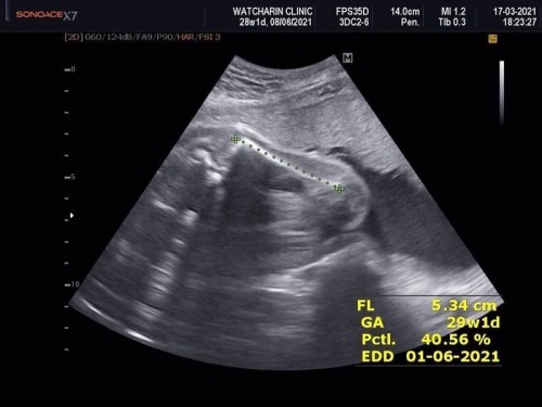 อัลตร้าซาวพบว่าลูกขดตัวจนตัวงอ