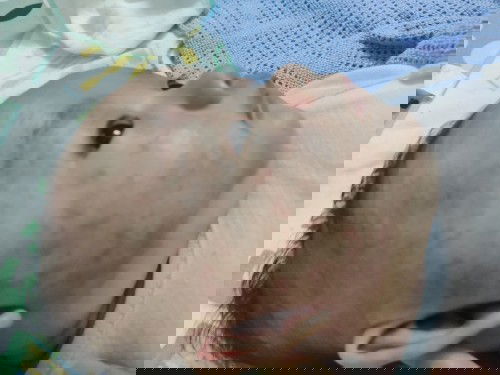 Đến tháng thứ 3 mới dị ứng sữa?