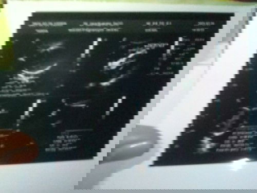 Binggung usg akurat?