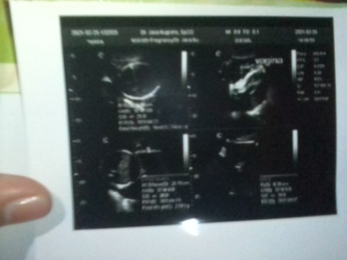 Binggung usg akurat?