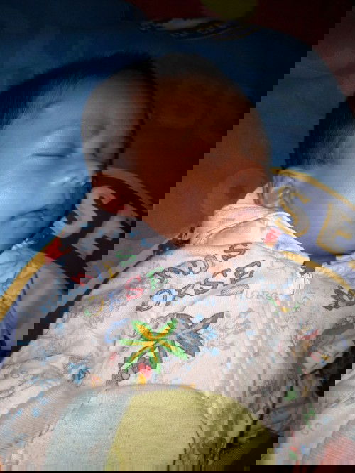 Benjolan keras didahi