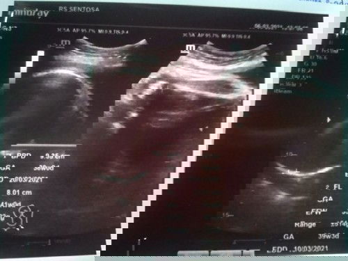 Perkiraan persalinan lewat dari hasil USG