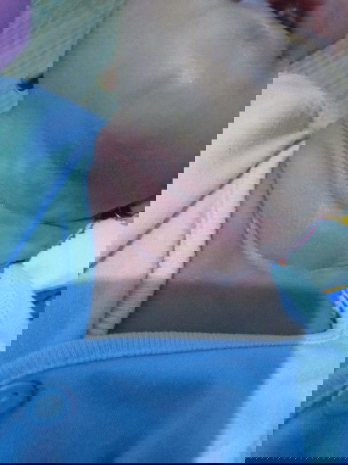 Ruam di Leher Bayi Newborn