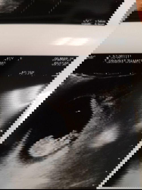 หิวบ่อยๆ หิวมากๆแล้วคลื่นไส้ เรียกว่าแพ้ท้องมั้ยคะ กินแล้วก็หาย