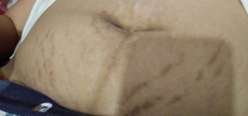 Stretch Marks