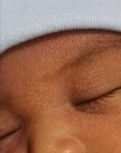 Cradle cap po kaya ito?