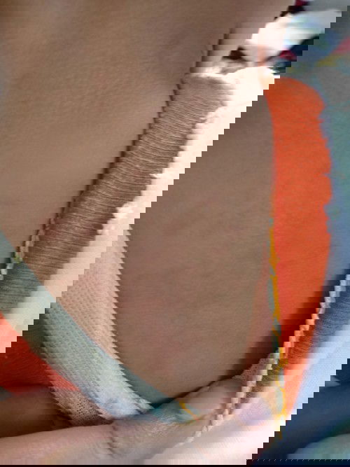 Merah-merah pada kulit bayi