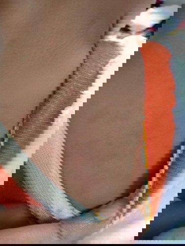 Merah-merah pada kulit bayi