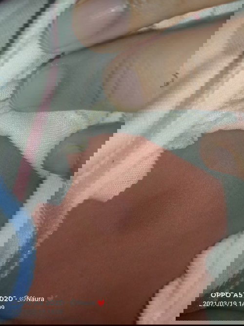 Khawatir ada benjolan