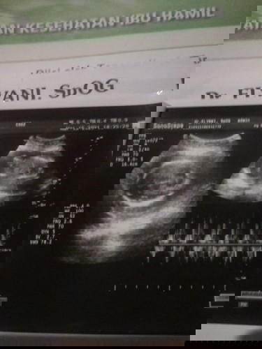 Saya hamil 24minggu BB q KK naik turun kenapa ya?BB bayi q masih 6ons