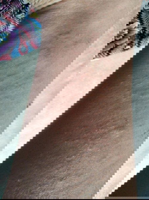 Muncul bintik merah dikaki