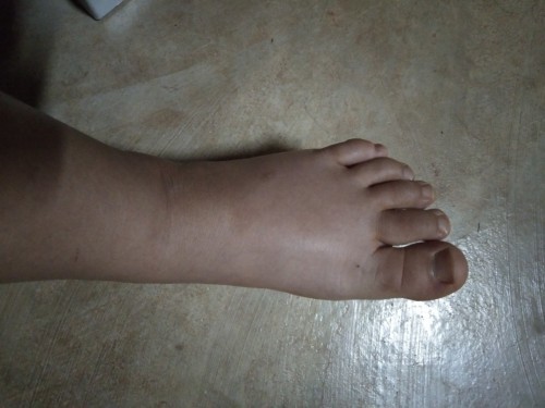 คุณแม่บ้านไหนเท้าบวมบ้าง