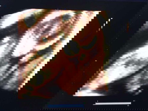 hamil janin besar diusia 14minggu