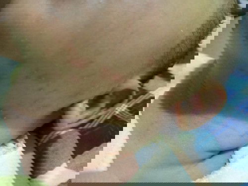 Bentol seperti jerawat di wajah dan leher