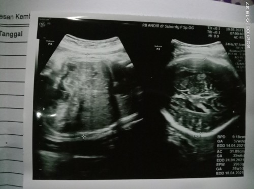 Foto hasil USG