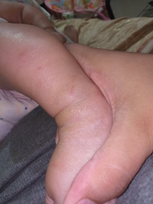 Dry skin.