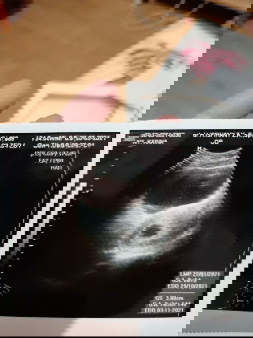 Hamil 7Week namun janin belum terlihat di kantung kehamilan